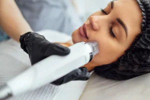 Microneedling Radio Frequency Treatment