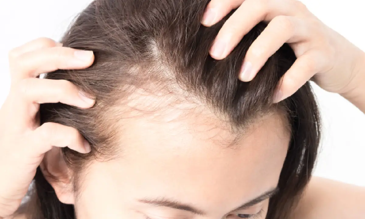 Thinning Hair in Women in Boynton Beach, FL